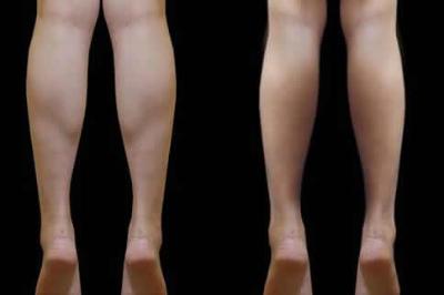 脂肪腿和肌肉腿混合怎么瘦?科学方法助你减脂塑形