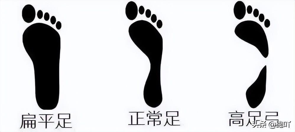 足底筋膜炎相关图片12