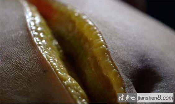 脂肪肝相关图片3